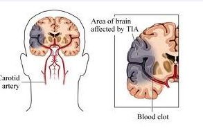 Transient Ischemic Attacks